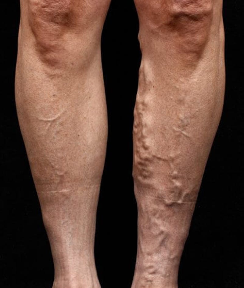 Varicose Veins Before & After Gallery - Patient 37499760 - Image 1