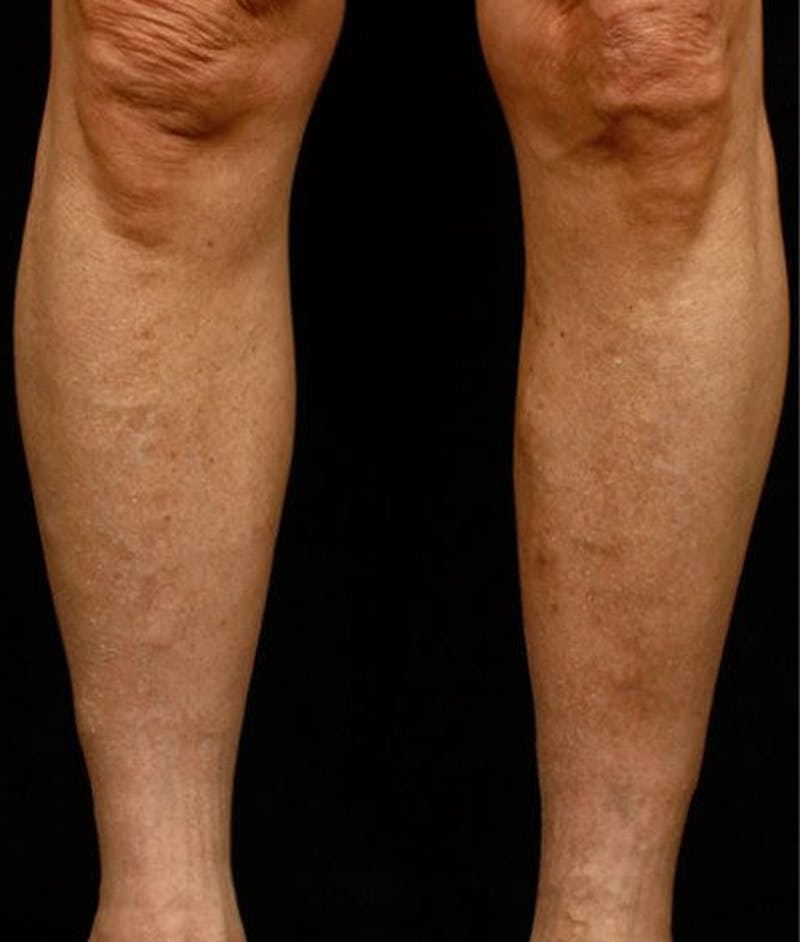 Varicose Veins Before & After Gallery - Patient 37499760 - Image 2