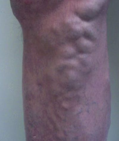 Varicose Veins Before & After Gallery - Patient 37499765 - Image 1