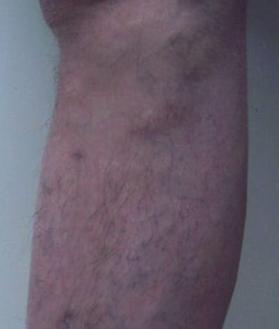 Varicose Veins Before & After Gallery - Patient 37499765 - Image 2