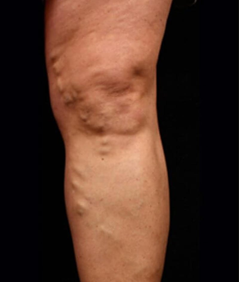 Varicose Veins Before & After Gallery - Patient 37499769 - Image 1