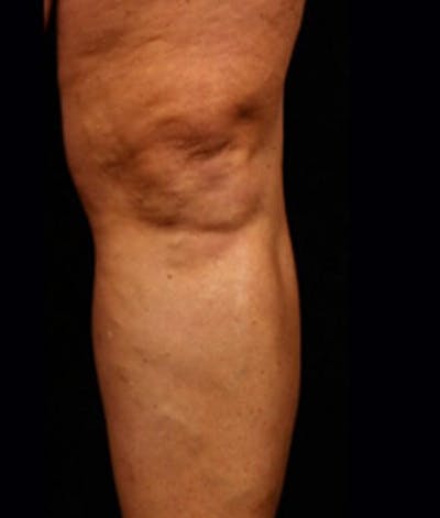 Varicose Veins Before & After Gallery - Patient 37499769 - Image 2