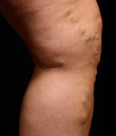 Varicose Veins Before & After Gallery - Patient 37499772 - Image 1