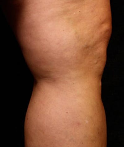 Varicose Veins Before & After Gallery - Patient 37499772 - Image 2