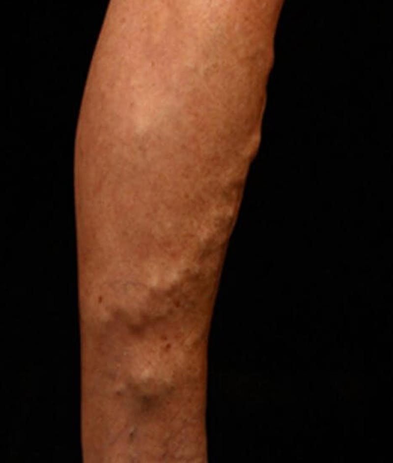 Varicose Veins Before & After Gallery - Patient 37499775 - Image 1