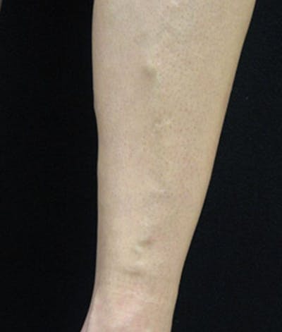 Varicose Veins Before & After Gallery - Patient 37499777 - Image 1