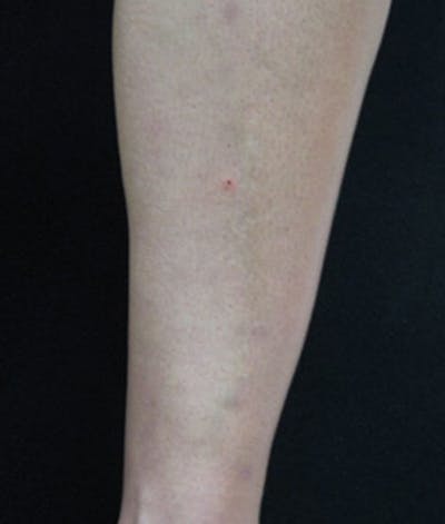 Varicose Veins Before & After Gallery - Patient 37499777 - Image 2