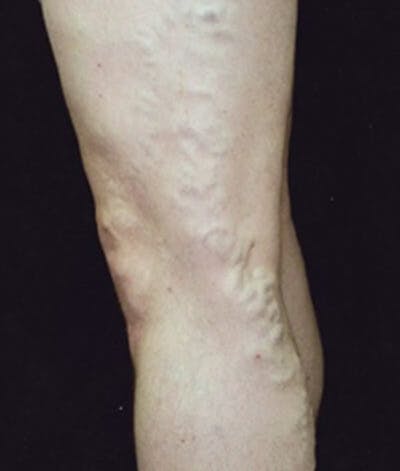 Varicose Veins Before & After Gallery - Patient 37499779 - Image 1