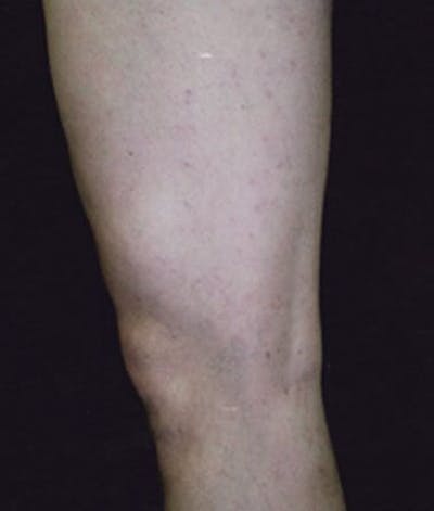 Varicose Veins Before & After Gallery - Patient 37499779 - Image 2