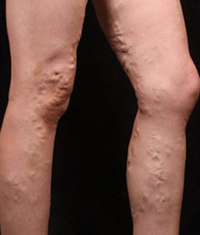 Varicose Veins Before & After Gallery - Patient 37499781 - Image 1