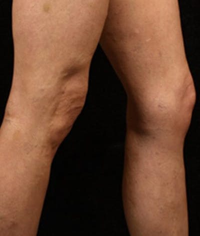 Varicose Veins Before & After Gallery - Patient 37499781 - Image 2
