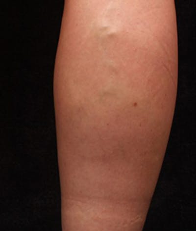 Varicose Veins Before & After Gallery - Patient 37499783 - Image 1
