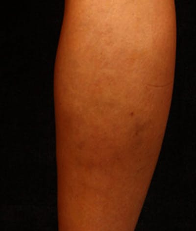 Varicose Veins Before & After Gallery - Patient 37499783 - Image 2
