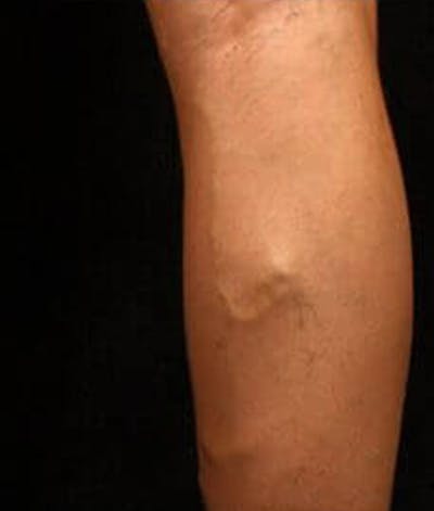 Varicose Veins Before & After Gallery - Patient 37499785 - Image 1
