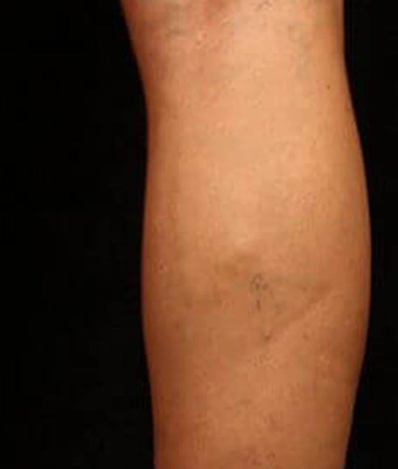 Varicose Veins Before & After Gallery - Patient 37499785 - Image 2