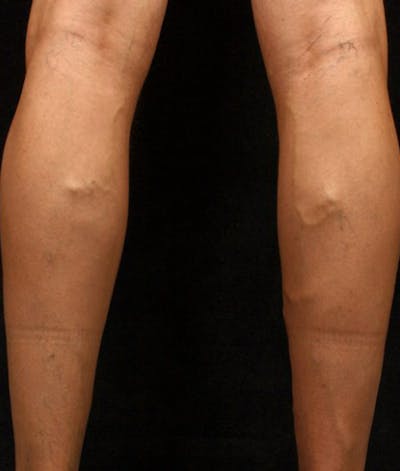 Varicose Veins Before & After Gallery - Patient 37499787 - Image 1