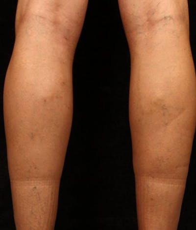 Varicose Veins Before & After Gallery - Patient 37499787 - Image 2