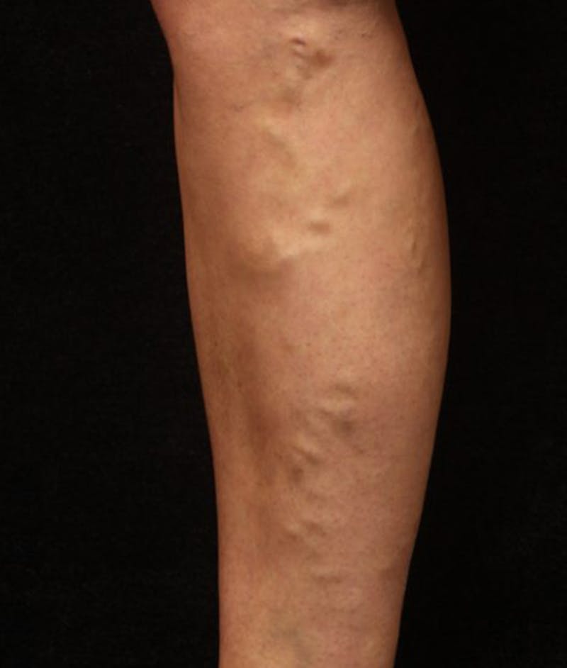 Varicose Veins Before & After Gallery - Patient 37499794 - Image 1