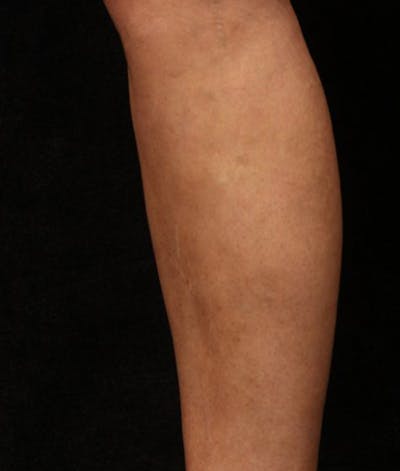 Varicose Veins Before & After Gallery - Patient 37499794 - Image 2