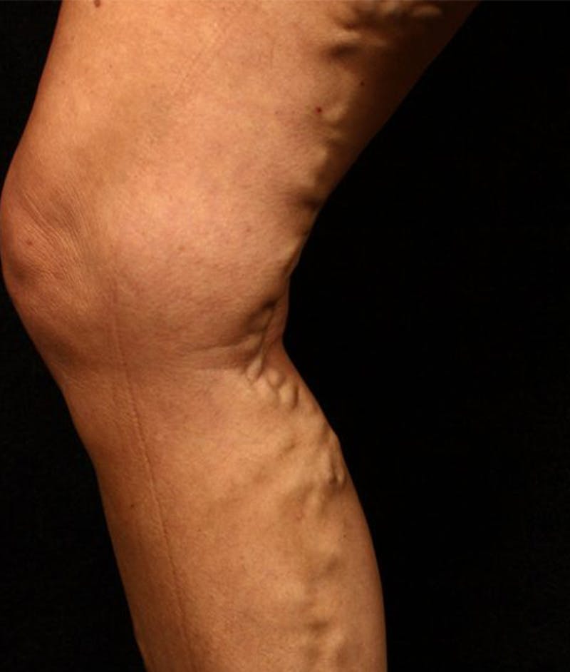 Varicose Veins Before & After Gallery - Patient 37499796 - Image 1