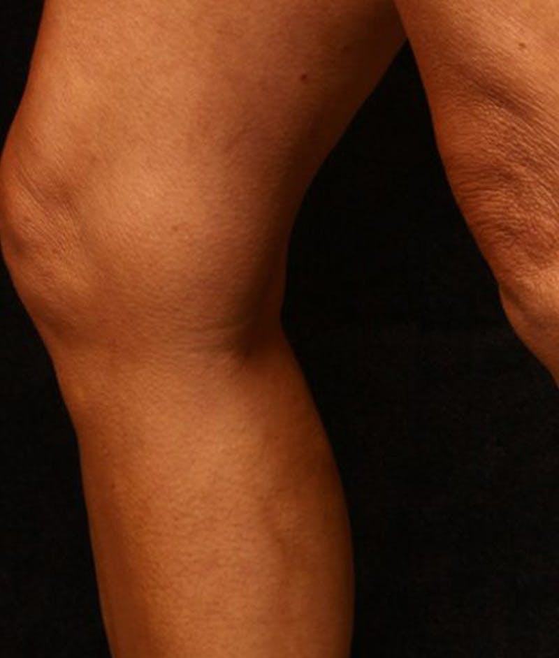Varicose Veins Before & After Gallery - Patient 37499796 - Image 2