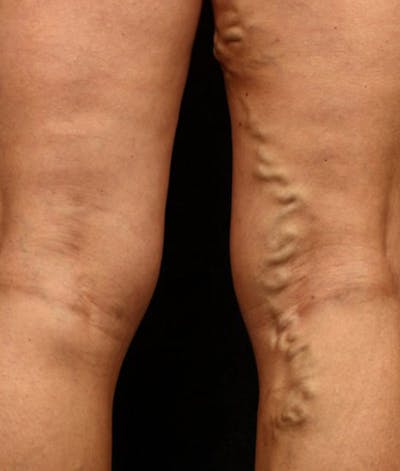 Varicose Veins Before & After Gallery - Patient 37499798 - Image 1