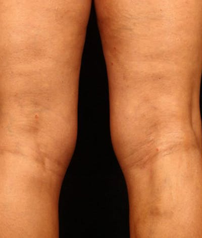 Varicose Veins Before & After Gallery - Patient 37499798 - Image 2