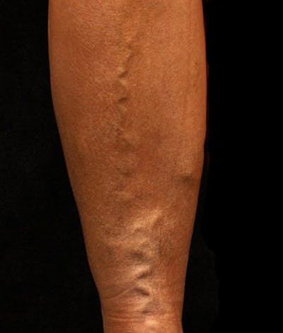 Varicose Veins Before & After Gallery - Patient 37499801 - Image 1