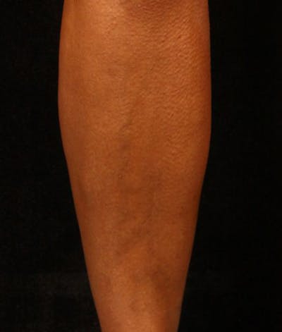 Varicose Veins Before & After Gallery - Patient 37499801 - Image 2