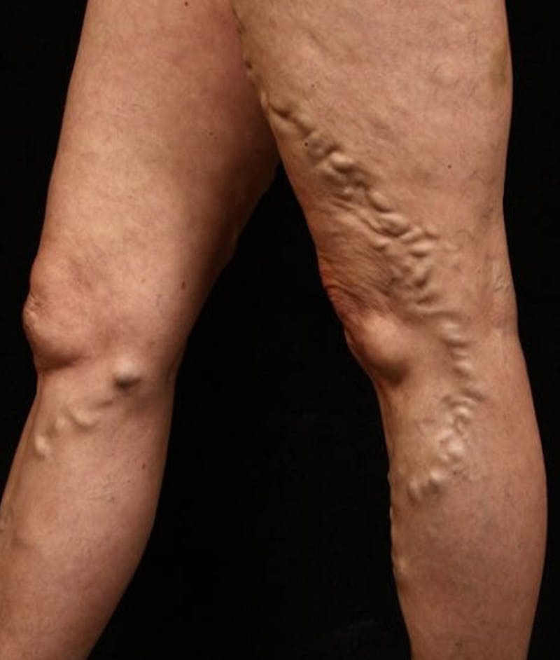 Varicose Veins Before & After Gallery - Patient 37499803 - Image 1
