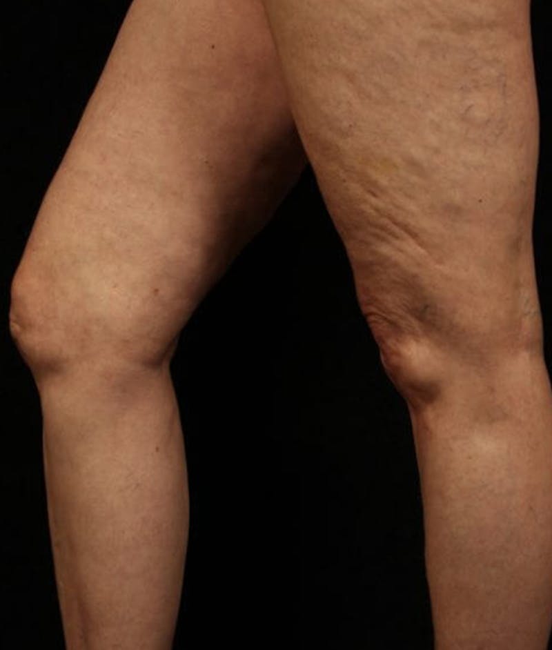 Varicose Veins Before & After Gallery - Patient 37499803 - Image 2