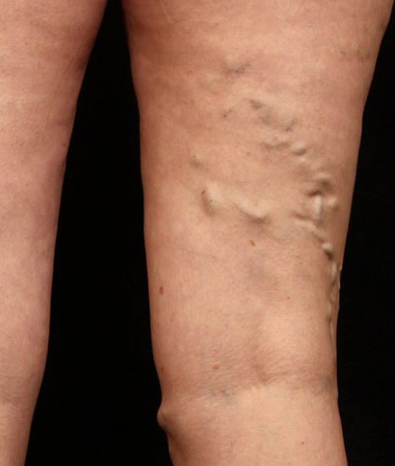 Varicose Veins Before & After Gallery - Patient 37499805 - Image 1