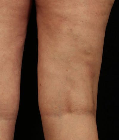 Varicose Veins Before & After Gallery - Patient 37499805 - Image 2