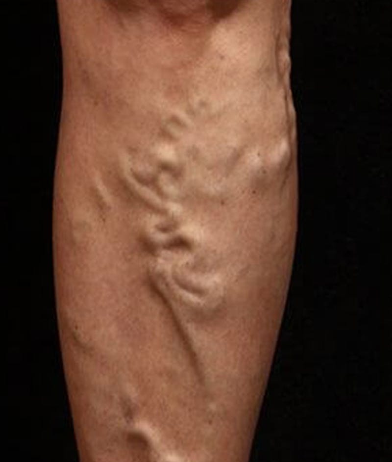 Varicose Veins Before & After Gallery - Patient 37499807 - Image 1