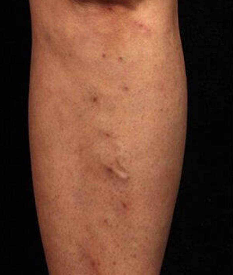 Varicose Veins Before & After Gallery - Patient 37499807 - Image 2