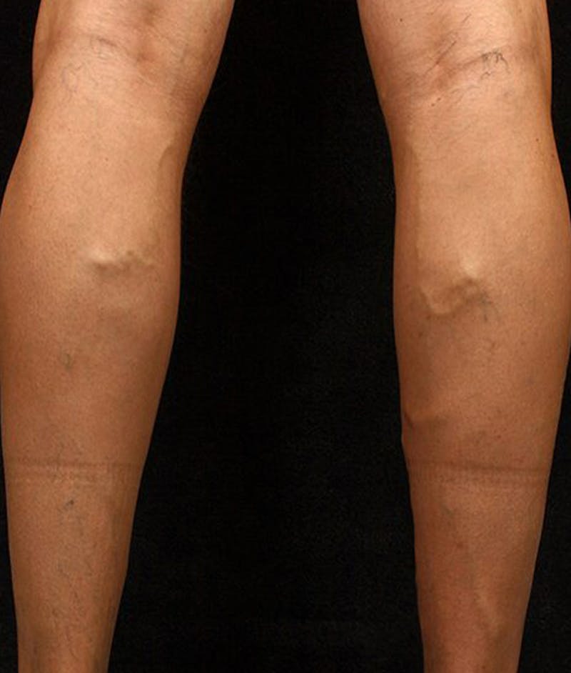 Varicose Veins Before & After Gallery - Patient 37499809 - Image 1