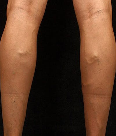 Varicose Veins Before & After Gallery - Patient 37499809 - Image 1