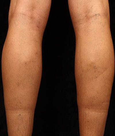 Varicose Veins Before & After Gallery - Patient 37499809 - Image 2