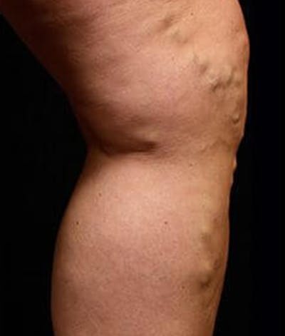 Varicose Veins Before & After Gallery - Patient 37499812 - Image 1