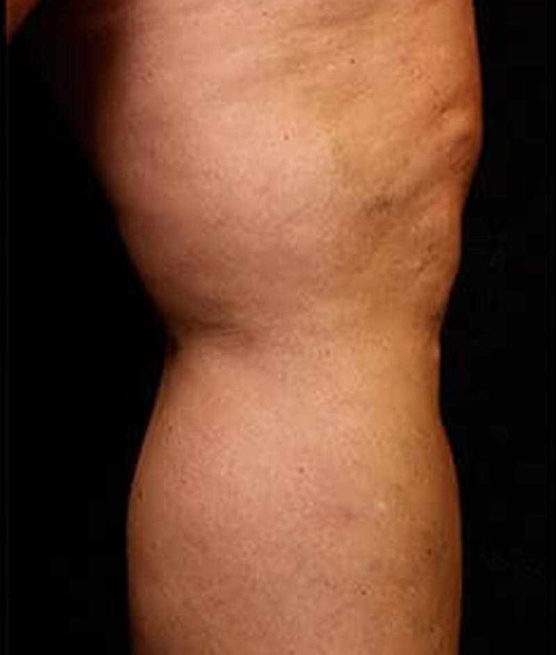 Varicose Veins Before & After Gallery - Patient 37499812 - Image 2