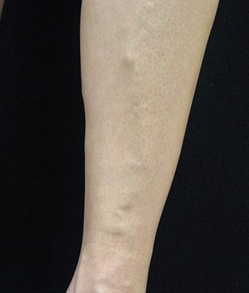 Varicose Veins Before & After Gallery - Patient 37499814 - Image 1