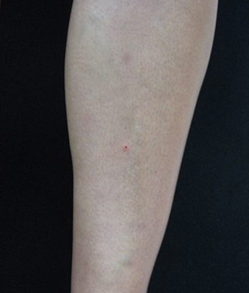 Varicose Veins Before & After Gallery - Patient 37499814 - Image 2