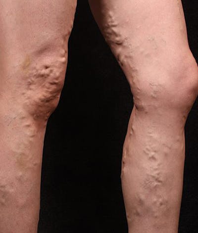 Varicose Veins Before & After Gallery - Patient 37499816 - Image 1