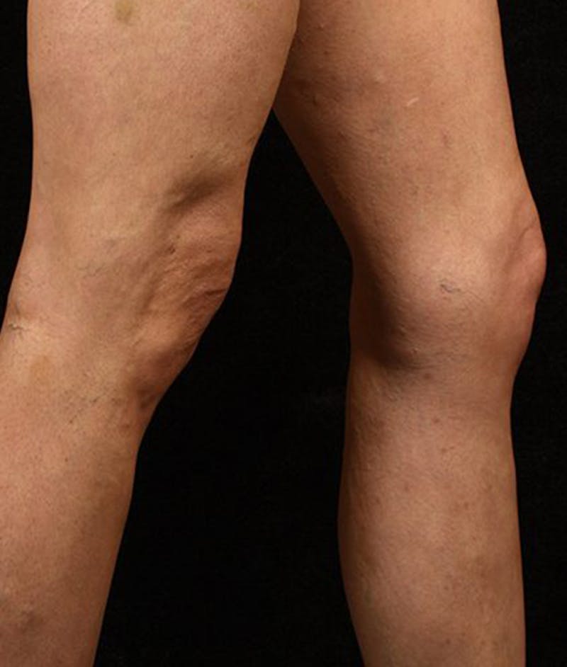 Varicose Veins Before & After Gallery - Patient 37499816 - Image 2