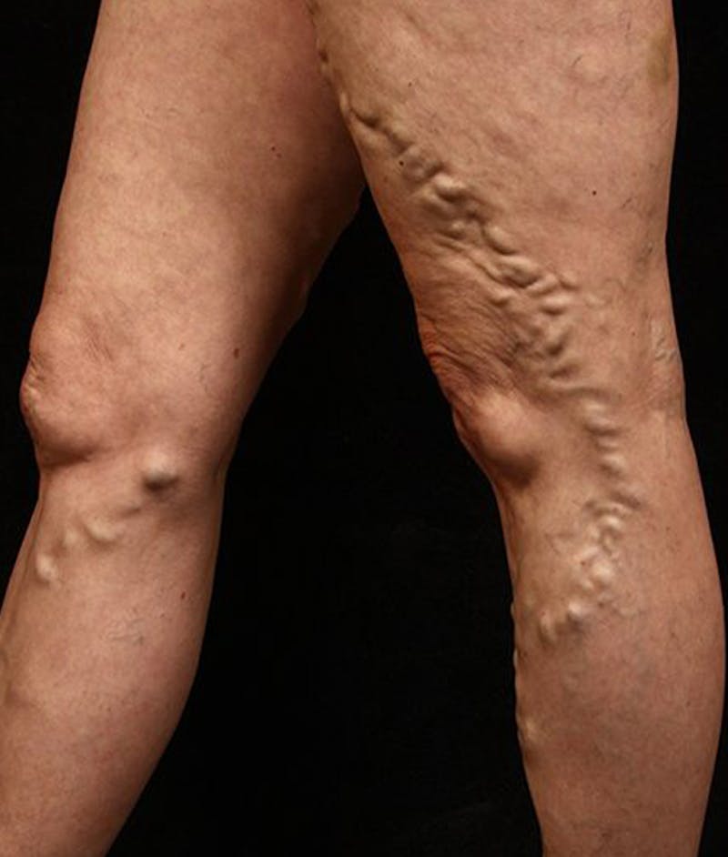Varicose Veins Before & After Gallery - Patient 37499818 - Image 1