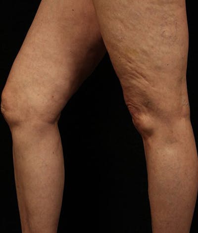 Varicose Veins Before & After Gallery - Patient 37499818 - Image 2