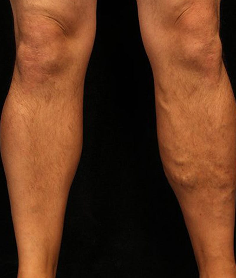 Varicose Veins Before & After Gallery - Patient 37499820 - Image 1