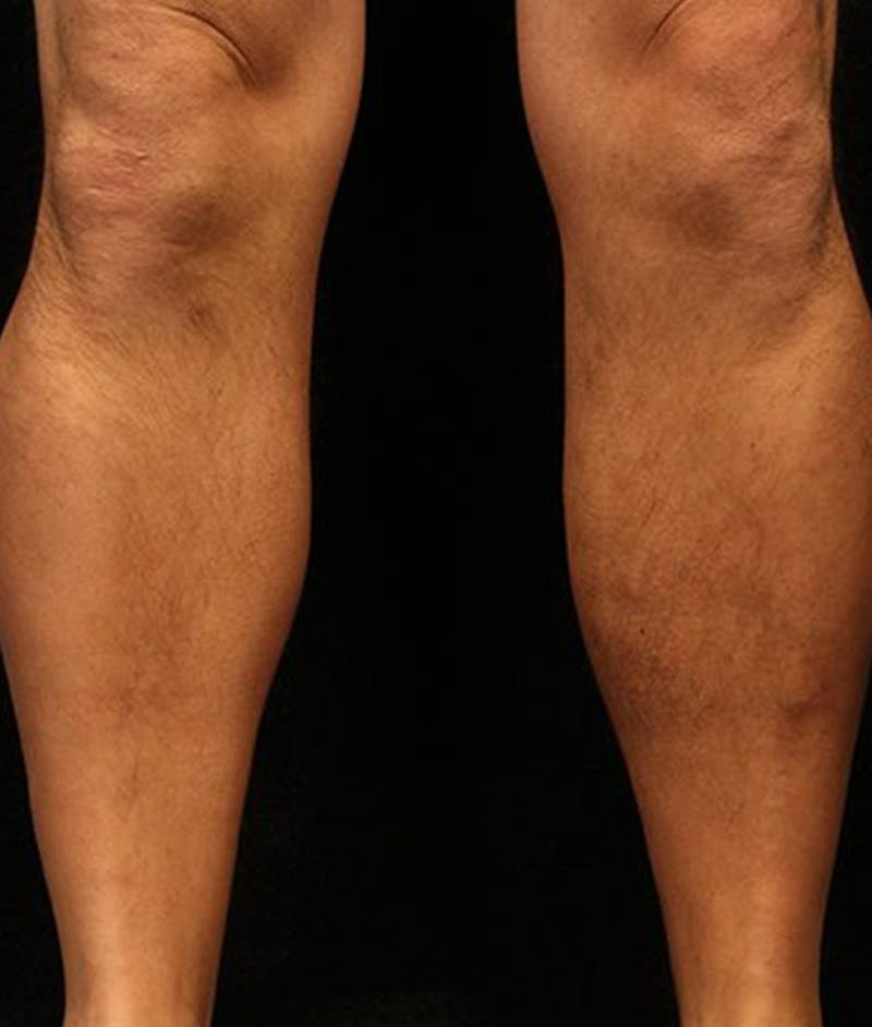 Varicose Veins Before & After Gallery - Patient 37499820 - Image 2