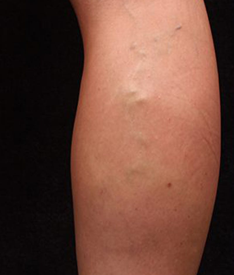 Varicose Veins Before & After Gallery - Patient 37499823 - Image 1