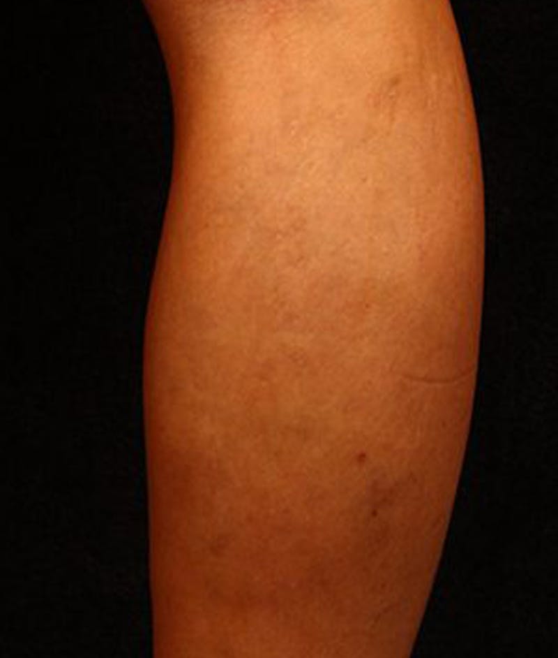 Varicose Veins Before & After Gallery - Patient 37499823 - Image 2